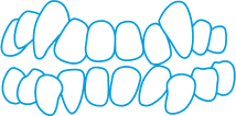 A blue outline drawing of two rows of misaligned human teeth, showing an irregular and crowded arrangement in both the upper and lower jaws.